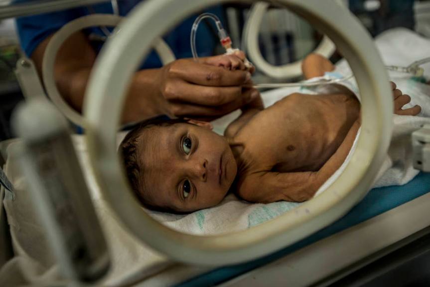 Esteban Granadillo, 18 days, who weighs 4 pounds 10 ounces, at Dr. Agustín Zubillaga University Hospital of Pediatrics in Barquisimeto, Venezuela.